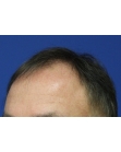 Before Hair Transplant&nbsp;Front